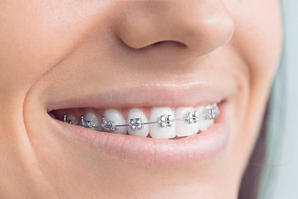 Close-up of a smiling lips with ceramic braces, showcasing straight white teeth and a natural pink lip color